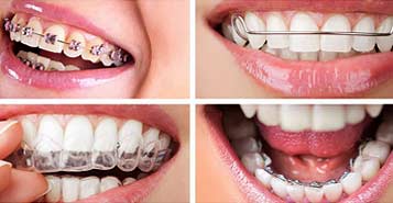 South Calgary Orthodontist | McKenzie Orthodontics | Orthodontic Braces Types