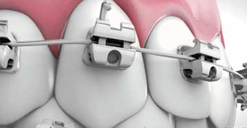 South Calgary Orthodontist | McKenzie Orthodontics | 3M Unitek Braces