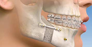 South Calgary Orthodontist | McKenzie Orthodontics | Surgical Orthodontics