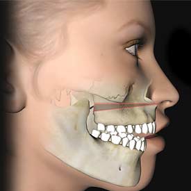 South Calgary Orthodontist | McKenzie Orthodontics | Corrective Jaw Surgery