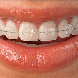 South Calgary Orthodontist | McKenzie Orthodontics | Damon Braces